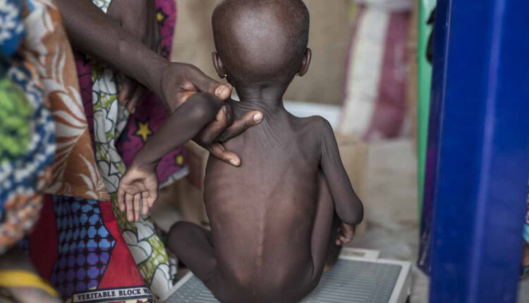 Gombe Govt Reaffirms Commitment to Tackling Malnutrition