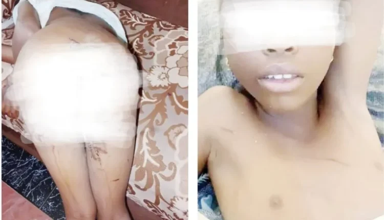 7-year-old victim hospitalized with severe burns after witchcraft accusation